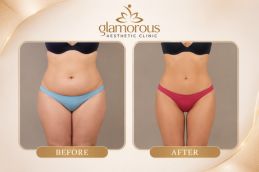 Laser Liposuction Before and After result Islamabad