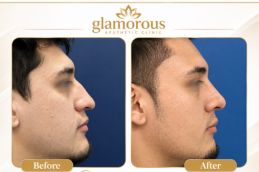 Male Rhinoplasty result Rwalpindi Islamabad , Pakistan