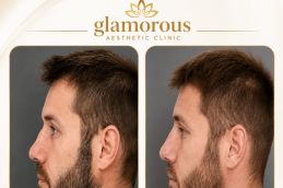 Male Rhinoplasty results Islamabad (1)