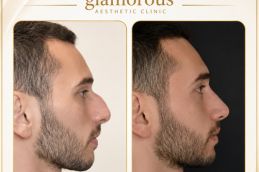 Male Rhinoplasty results Islamabad , Pakistan