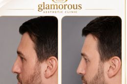 Male Rhinoplasty results Islamabad Pakistan