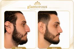 Male Rhinoplasty results Islamabad