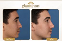 Male Rhinoplasty results Rwalpindi Islamabad , Pakistan