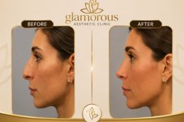 Nose tip plasty before and after Islamabad Pakistan