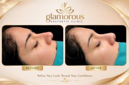 Rhinoplasty Recovery Timeline Week-by-Week Before and After Results