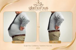 Tummy Tuck Recovery Guide Before and After