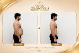 Tummy Tuck Recovery Guide Before and After