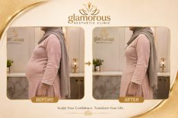 Tummy Tuck Recovery Guide Before and After