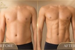 Vaser 4D Liposuctin Before and After result
