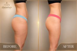 Vaser 4D Liposuctin Before and After result Islamabad
