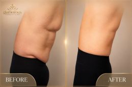 Vaser 4D Liposuctin Before and After results