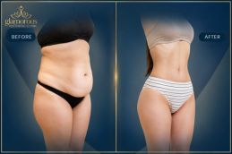 Vaser 4D Liposuctin Before and After results Islamabad