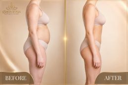 Vaser 4D Liposuctin Before and After results pakistan