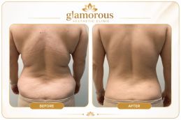 Vaser 4D Liposuctin Besore and After results Islamabad Pakistan