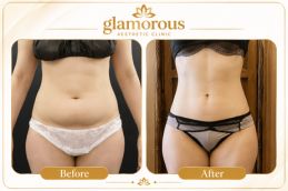 Vaser 4D Liposuctin results Islamabad Pakistan (1)
