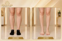 calf reduction Before and after results