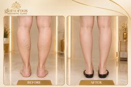 calf reduction Before and after results Rawalpindi Islamabad Pakistan