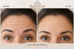 cosmetic injectables before and after results