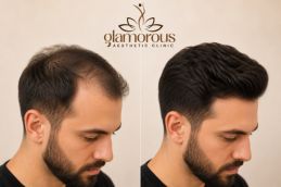 BEFOR AND AFTER OF Hair Transplant