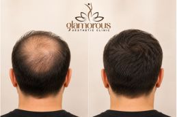 BEST BEFOR AND AFTER OF Hair Transplant