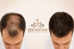 Befor and After PRP Hair Treatment in Islamabad