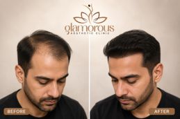 Befor and After of Best Age to Get a Hair Transplant in Islamabad