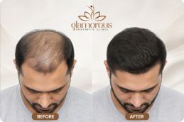 Befor and After of Best Age to Get a Hair Transplant in Islamabad