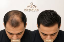 Befor and After of Best Age to Get a Hair Transplant in Islamabad