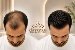 Befor and After of Hair Transplant in Islamabad