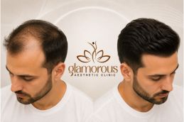 Befor and After of Hair Transplant in Islamabad