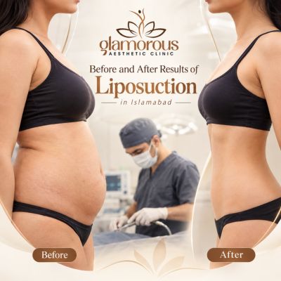 Before and After results of Liposuction in Islamabad