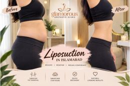 Before and After results of Liposuction in Islamabad, Best Before and After results of Liposuction in Islamabad