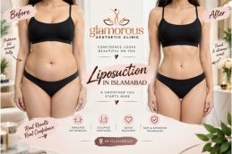 Before and After results of Liposuction in Islamabad, Best Before and After results of Liposuction in Islamabad