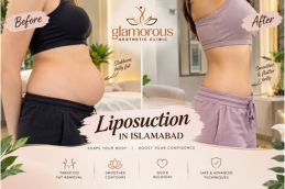 Before and After results of Liposuction in Islamabad , Best Before and After results of Liposuction in Islamabad