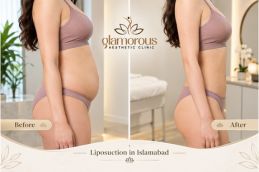 Before and After results of Liposuction in Islamabad , Best Before and After results of Liposuction in Islamabad