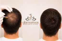 Best Befor and After PRP Hair Treatment in Islamabad