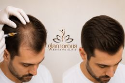 Best Befor and After PRP Hair Treatment in Islamabad