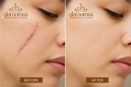 befor and after result surgical scar