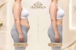 before and after results of ozempic injections