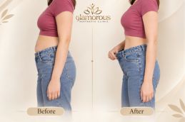 before and after results of ozempic injections in Islamabad
