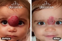 Befor and After of Hemangiomas Treatment in Islamabad