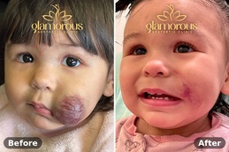 Hemangiomas Treatment in Islamabad , Best Hemangiomas Treatment in Islamabad