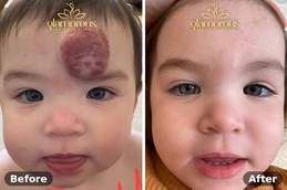 Befor and After of Hemangiomas Treatment in Islamabad