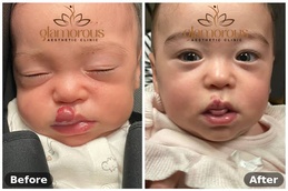 Befor and After of Hemangiomas Treatment in Islamabad