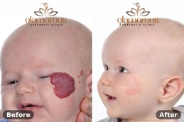 Befor and After of Hemangiomas Treatment in Islamabad