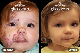Befor and After of Hemangiomas Treatment in Islamabad